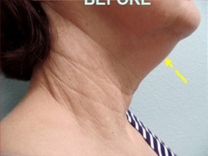 Neck Lifts