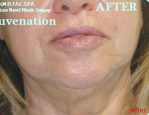 Neck Lifts Case 4962 After Photo Neck Lifts