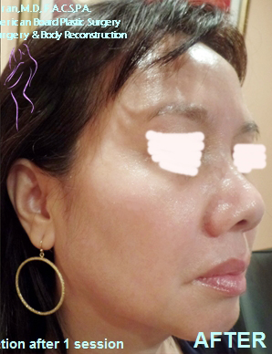 Face Rejuvenation Case 4658 After Photo Face Rejuvenation