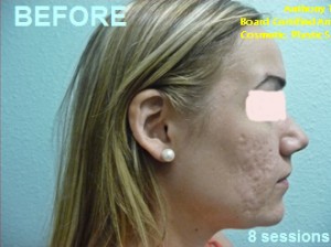 Face Rejuvenation