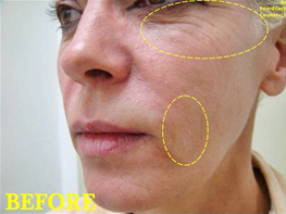 Face Rejuvenation Case 4698 Before Photo Face Rejuvenation