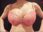 Breast Augmentation