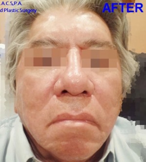 Face Rejuvenation Case 4596 After Photo Face Rejuvenation