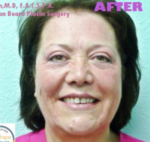 Face Rejuvenation Case 4738 After Photo Face Rejuvenation