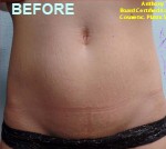 Stretchmarks Removal