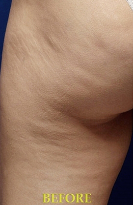 Cellulite Removal Case 4908 Before Photo Cellulite Removal