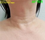 Neck Lifts