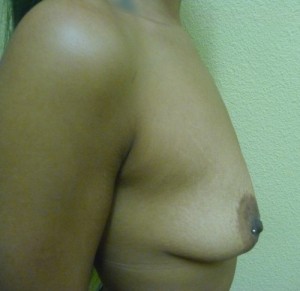 Breast Augmentation Case 5816 Before Photo Breast Augmentation