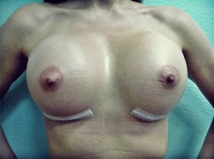 Breast Augmentation