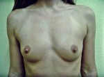 Breast Augmentation