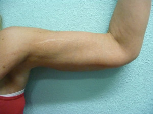 Arm Lift Case 5820 After Photo Arm Lift