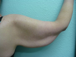 Arm Lift Case 5820 Before Photo Arm Lift