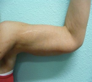 Arm Lift Case 5820 After Photo Arm Lift
