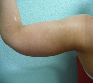 Arm Lift Case 5820 After Photo Arm Lift
