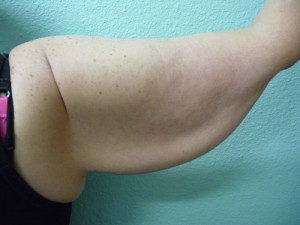 Arm Lift Case 5820 Before Photo Arm Lift
