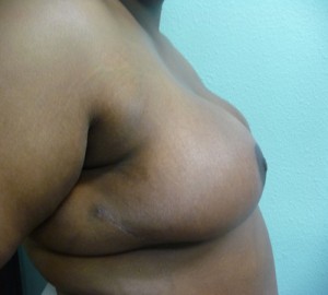 Breast Reduction