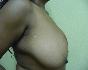 Breast Reduction