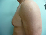 Gynecomastia