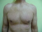 Gynecomastia