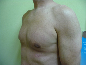 Gynecomastia