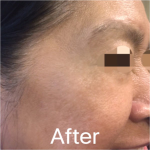 ThermiSmooth Face Case 6537 After Photo ThermiSmooth Face