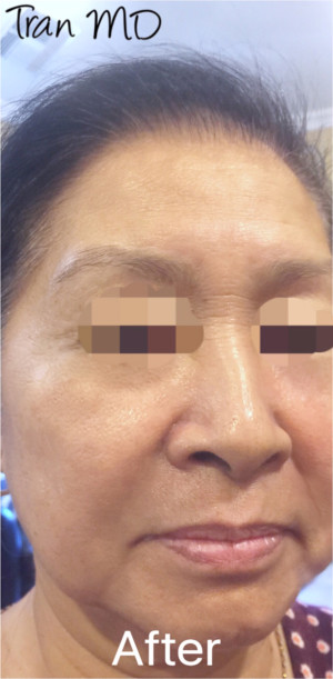 ThermiSmooth Face Case 6537 After Photo ThermiSmooth Face