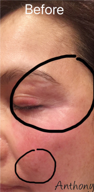 ThermiSmooth Face Case 6545 Before Photo ThermiSmooth Face
