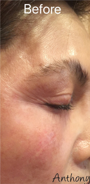 ThermiSmooth Face Case 6545 Before Photo ThermiSmooth Face
