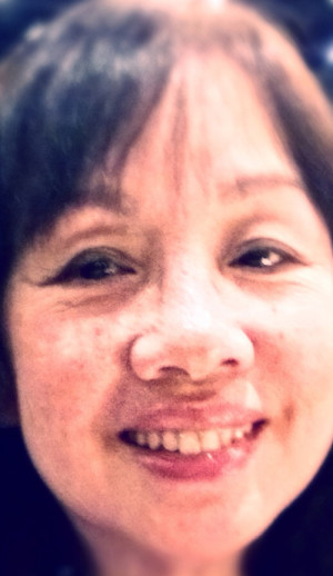 Eye Lid Surgery Case 6686 Before Photo Eye Lid Surgery