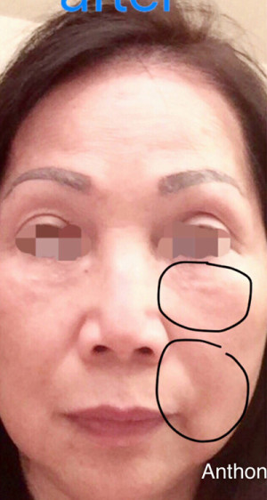 ThermiSmooth Face Case 6689 Before Photo ThermiSmooth Face