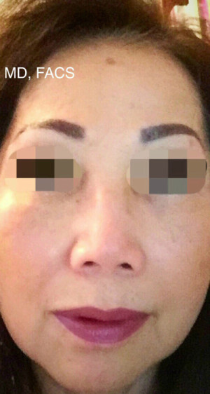 ThermiSmooth Face Case 6689 After Photo ThermiSmooth Face