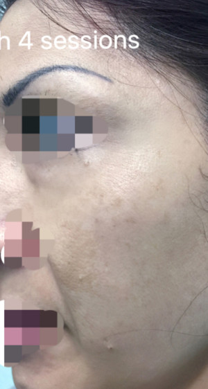 ThermiSmooth Face Case 6690 After Photo ThermiSmooth Face