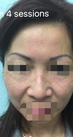 ThermiSmooth Face Case 6690 After Photo ThermiSmooth Face