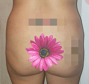 Butt Augmentation