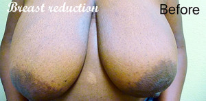 Breast Reduction Case 6831 Before Photo Breast Reduction