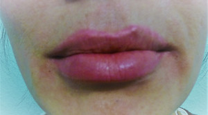 Fillers Case 6815 After Photo Fillers