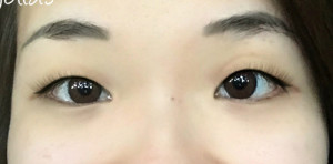 Eye Lid Surgery Case 6876 Before Photo Eye Lid Surgery
