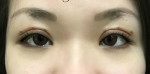 Eye Lid Surgery