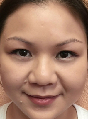 Microblading Case 7211 Before Photo Microblading