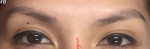 Microblading