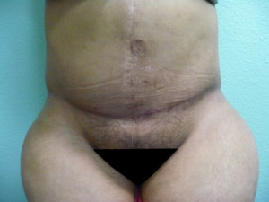 Tummy Tuck