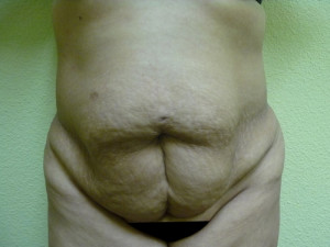 Tummy Tuck