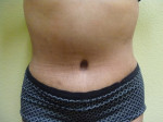 Tummy Tuck