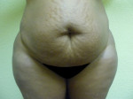 Tummy Tuck