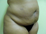 Tummy Tuck