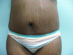 Tummy Tuck