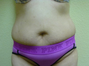 Tummy Tuck