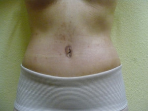 Tummy Tuck