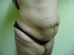 Tummy Tuck