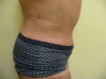 Tummy Tuck